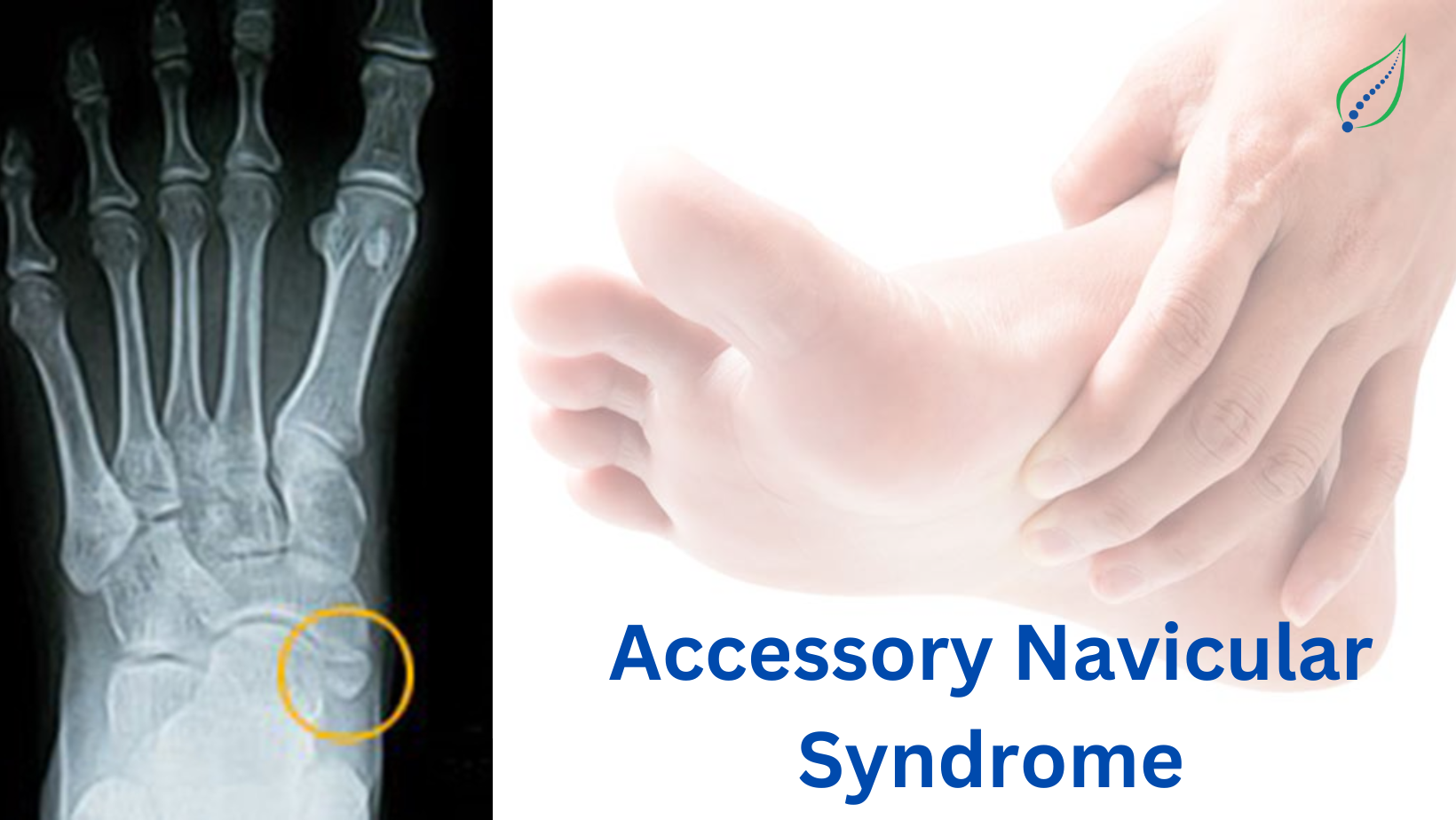 Accessory Navicular Bone Understanding Its Anatomy And Implications